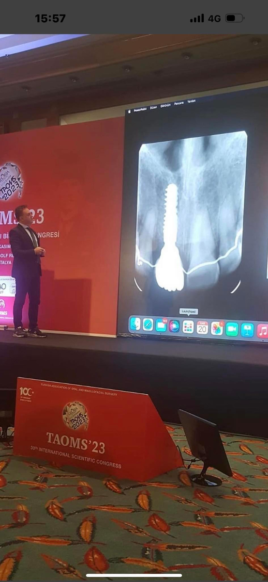 İncelmiş Yetersiz Kemikte İmplant Tedavisi